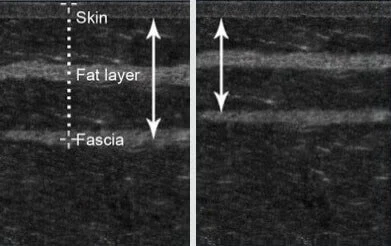 burnrizer účinky aplikace burnrizer účinky aplikace