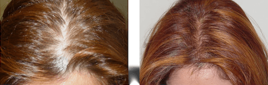 Hairstim Auswirkungen Hairstim Auswirkungen
