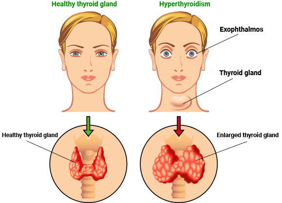 Thyrolin thyroid